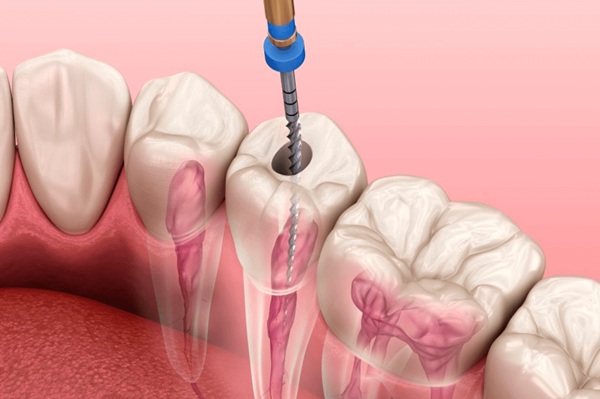 Root Canal